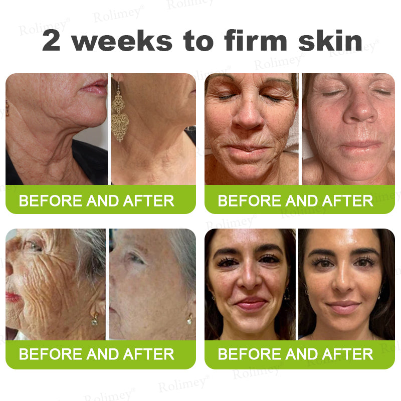 👨‍⚕️💙Made and shipped from Australia 💫Rolimey® Botox & Vita-A Retinol Shot Wrinkle-Lift Tightening cream - Last Day Promotion 70% OFF