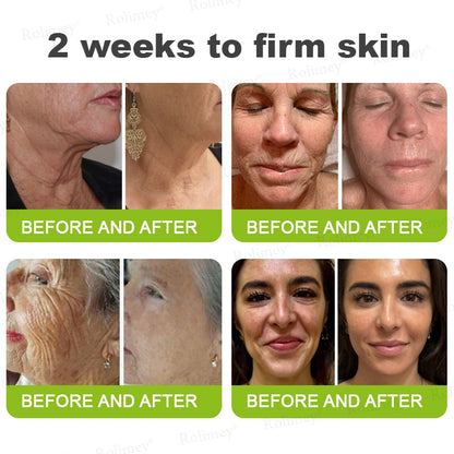 👨‍⚕️💙Made and shipped from Australia 💫Rolimey® Botox & Vita-A Retinol Shot Wrinkle-Lift Tightening cream - Last Day Promotion 70% OFF