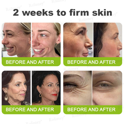 👨‍⚕️💙Made and shipped from Australia 💫Rolimey® Botox & Vita-A Retinol Shot Wrinkle-Lift Tightening cream - Last Day Promotion 70% OFF