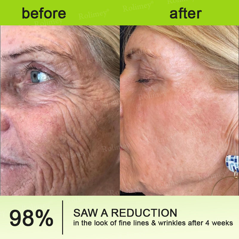 👨‍⚕️💙Made and shipped from Australia 💫Rolimey® Botox & Vita-A Retinol Shot Wrinkle-Lift Tightening cream - Last Day Promotion 70% OFF
