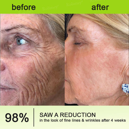 👨‍⚕️💙Made and shipped from Australia 💫Rolimey® Botox & Vita-A Retinol Shot Wrinkle-Lift Tightening cream - Last Day Promotion 70% OFF
